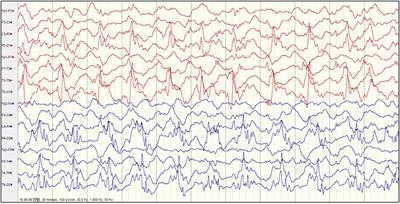 Clinical Attributes and Electroencephalogram Analysis of Patients With Varying Alpers’ Syndrome Genotypes